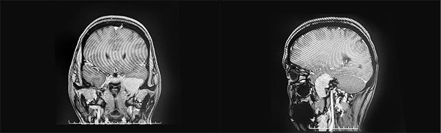 腫瘤位于左側顱中窩顳葉內(nèi)側底部