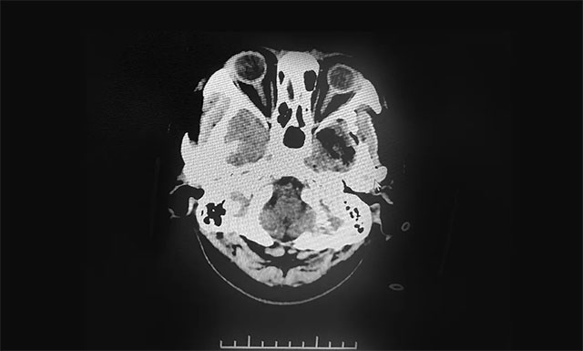 術后影像顯示腫瘤被切除