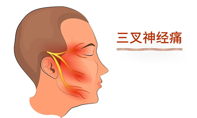 三叉神經痛有“天下第一痛”之稱