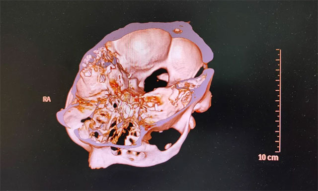 為患者開展多點射頻熱凝術治療